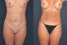 Full Tummy Tuck