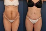 Full tummy tuck