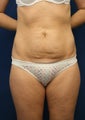 Abdominoplasty with Liposuction