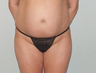 Abdominoplasty