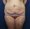 Tummy Tuck