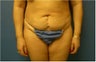 Abdominoplasty, Tummy Tuck, Liposuction