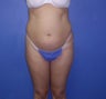 Tummy Tuck, Abdominoplasty, Liposuction