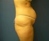 Tummy Tuck, Abdominoplasty, Liposuction