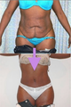 Tummy Tuck