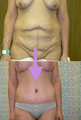 Tummy tuck