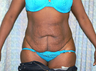 Tummy Tuck