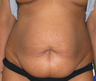 Abdominoplasty