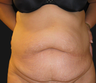 Abdominoplasty