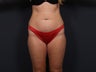 Tummy Tuck