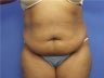 Tummy Tuck
