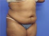 Tummy Tuck