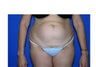 Tummy Tuck