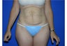 Tummy Tuck