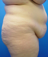 ABDOMINOPLASTY (TUMMY TUCK)