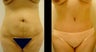 Abdominoplasty (Tummy Tuck)