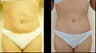 Abdominoplasty (Tummy Tuck)