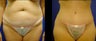 Abdominoplasty (Tummy Tuck)