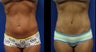 Abdominoplasty (Tummy Tuck)