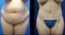 Abdominoplasty (Tummy Tuck)