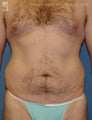 Tummy Tuck