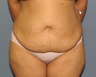 tummy tuck