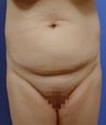 Abdominoplasty (Tummy Tuck)