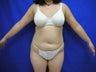 Tummy Tuck