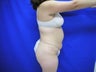 Tummy Tuck