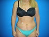 Tummy Tuck