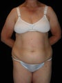 Abdominoplasty