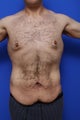 Tummy Tuck
