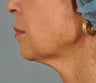 Ultherapy ~ lifting AND tightening for facelift results.