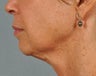 Ultherapy ~ lifting AND tightening for facelift results.