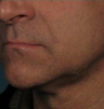 Ultherapy