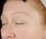 Ulthera Laser Skin Tightening