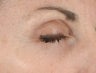 Ulthera Laser Skin Tightening