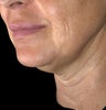 Ulthera Laser Skin Tightening