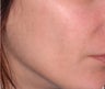 Ulthera Laser Skin Tightening