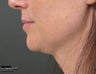 Ulthera Laser Skin Tightening