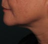 Ulthera Laser Skin Tightening