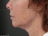 Ulthera Laser Skin Tightening