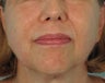 Ultherapy