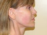 Ultherapy
