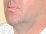 Ultherapy