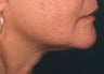 Ultherapy