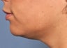 Ultherapy