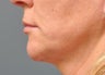 Ultherapy