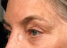 Ultherapy