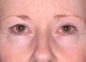 Ultherapy